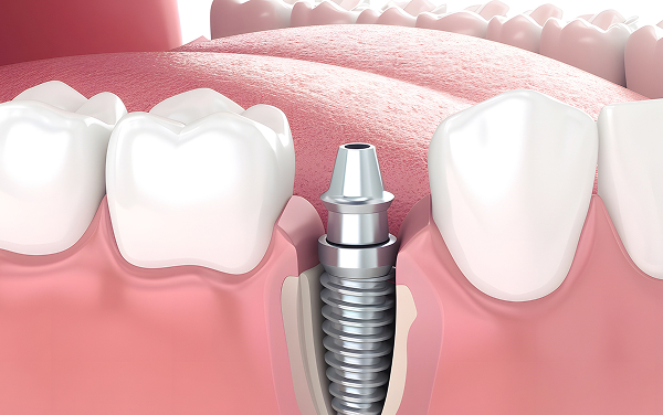 オステオインテグレーション期間