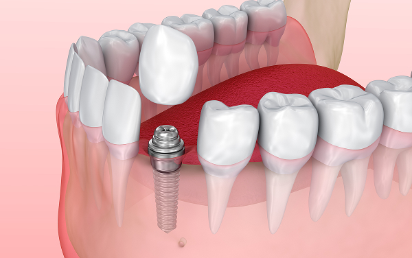 上部構造の取り付け